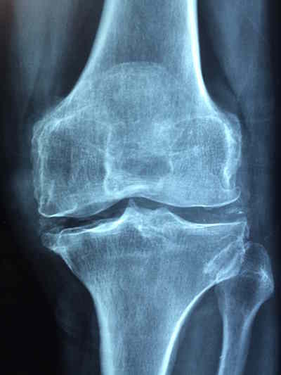 Röntgenaufnahme bei Osteoporose